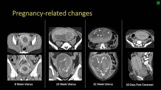 Gynecologic Radiology Anatomy [upl. by Sakovich110]