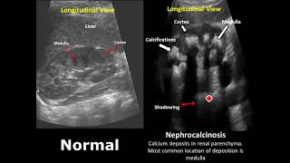 Kidney Ureter and Bladder KUB Ultrasound Normal Vs Abnormal Image Appearances Comparison [upl. by Aiderfla]