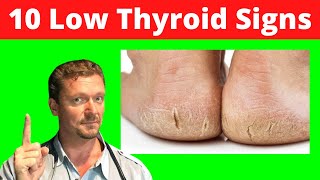 10 Skin Signs of LOW THYROID Skin Signs of Hypothyroidism 2024 [upl. by Kline]