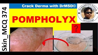 Dyshidrotic Eczema  POMPHOLYX  Causes Symptoms Diagnosis amp Treatment by Dr Maddineni Srinivas [upl. by Ramsa]