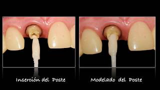 postes de fibra de vidrio dental [upl. by Zephan]