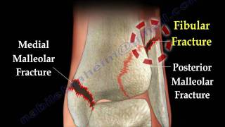 Ankle fracture  Fractures and its repair Everything You Need To Know  Dr Nabil Ebraheim [upl. by Donahoe]