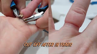 Removing Wedding Ring From Swollen Finger After 18 Years  WooGlobe [upl. by Rriocard]