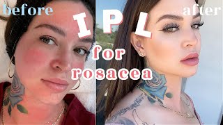 How I treat my ROSACEA  IPL Photofacial 👼🏼 THE FACIAL THAT CHANGED MY FACE [upl. by Fredrick691]