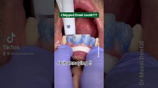 Chipped Front Tooth [upl. by Nalod]