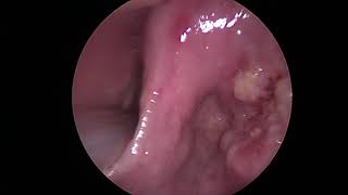 cancer paroi latérale sinus piriforme droit Epithelioma of the piriform sinus [upl. by Narak]