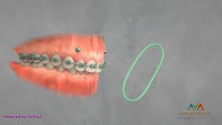 Orthodontic Treatment for Gummy Smile  TAD and Elastics [upl. by Ahsenad197]