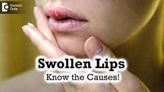 Swollen Lips Common CausesTriggers  Angioedema  Dr Rashmi Ravindra  Doctors Circle [upl. by Mathias236]