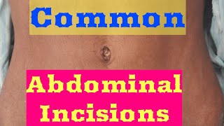 Common Abdominal Incisions [upl. by Annette127]