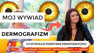 VLOG Pisanie po skórze w TV czyli Dermografizm [upl. by Adrian89]