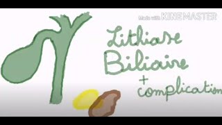 lithiase biliare et ses complications [upl. by Neve53]