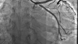 In stent restenosis of OSTIAL LCX [upl. by Naleag173]