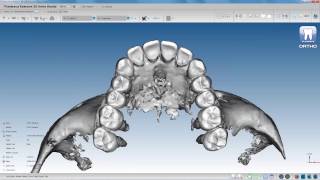 Planmeca Romexis 3D Ortho Studio – Orthodontic treatment planning with roots and bone surface [upl. by Hcire318]