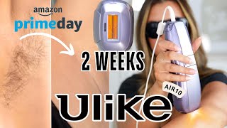 I Tried NEW Ulike Air10 IPL Hair Removal at Home BeforeAfter Results [upl. by Adore]