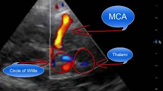 Transcranial Doppler Point of Care Ultrasound [upl. by Nehemiah]