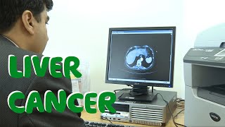 What Is Liver Cancer Symptoms Causes amp Treatments  Macmillan Cancer Support [upl. by Tien]