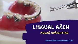 LingualArchforMolarUprighting [upl. by Hterag359]