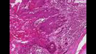 Histopathology Lung  Squamous cell carcinoma [upl. by Eglantine]