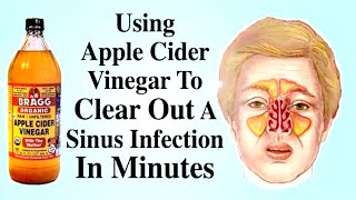 How To Kill Sinus Infection In a Short Time With Apple Cider Vinegar [upl. by Blas]