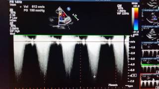 Echocardiogram  doublechambered right ventricle DCRV [upl. by Aiderfla814]