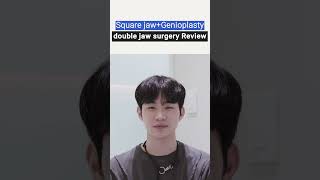 1 Year PostOp Review of Double Jaw Surgery for Male Lantern Jaw and Facial Asymmetry [upl. by Shawn]