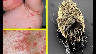 Scabies What Is It  Signs Symptoms Causes Spread and Treatment [upl. by Esmaria]