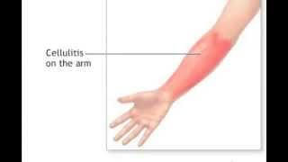 What Is Cellulitis [upl. by Nhguavaj]