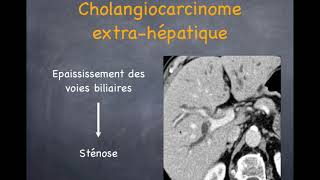 Tumeurs du foie  Malignes  3 Cholangiocarcinome [upl. by Gibb]