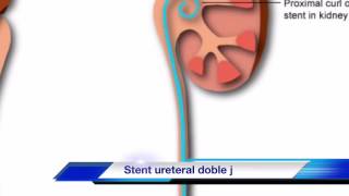 CATETER DOBLE J O STENT URETERAL [upl. by Nennahs981]