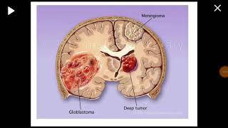 Glioblastoma multiforme Tomografía cerebral [upl. by Fraze470]