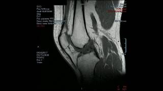 LCA acl  RMM Ginocchio  Legamento crociato anteriore MRI Knee  Anterior cruciate ligament [upl. by Burdelle]