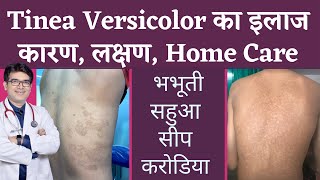 Tinea Versicolar Treatment  भभूतीसीपसहुआकरोडिया का इलाज  Pityriasis Versicolor  In Hindi [upl. by Elset]