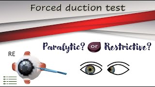 Forced duction test │Active force generation test [upl. by Oicaro492]