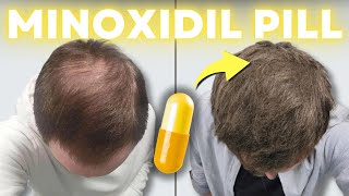 Oral Minoxidil  The TRUTH to Unlocking Your BEST Hair Growth [upl. by Atrim]