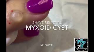 Myxoid cyst drainage and removal Mucous Cyst on finger Sinus tract of joint fluid MrPopZit [upl. by Lucille]