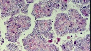 Thyroid Neoplasms  Pathology mini tutorial [upl. by Izmar973]