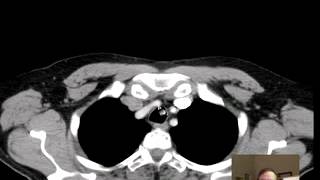 Chest CT Anatomy Discussion by Radiologist [upl. by Negaem]