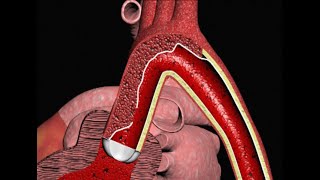 Treating Aortic Dissections [upl. by Minny]