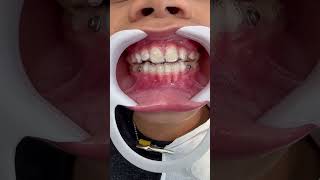 Alinhador invisível orto odonto ortodoncia alinhadoresinvisiveis invisalign aparelho [upl. by Irrep]