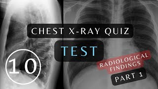 Can You Pass This Quiz Questions and Answers  10 Essential Chest Xrays xray respiratory [upl. by Mihalco]