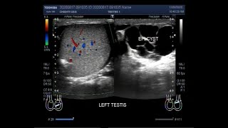 Ultrasound Video showing an Epididymal cyst [upl. by Ballinger]