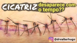 CICATRIZ Desaparece  Como Tirar Cicatrizes Dr Valter Hugo [upl. by Kirit]