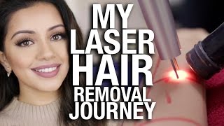 My Laser Hair Removal Journey [upl. by Lerrad]