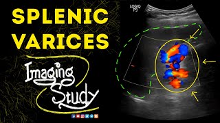 Splenic Varices  Ultrasound  Case 49 [upl. by Noraha]