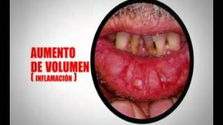 Queilitis Actínica [upl. by Eimaj]