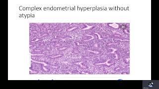 Endometrial hyperplasia Dr M Ramadan [upl. by Ahslek151]