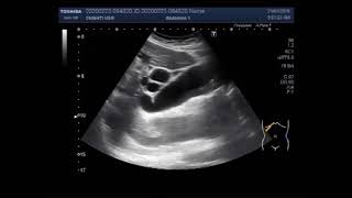 Ultrasound Video showing Cholelithiasis associated with Choledocholithiasis [upl. by Luane]