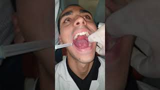 Local Anaesthesia Demonstration of Inferior Alveolar Nerve Block [upl. by Jael]