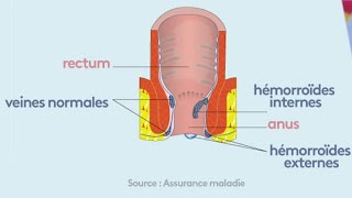 Santé  Tout sur les hémorroïdes [upl. by Arrik]