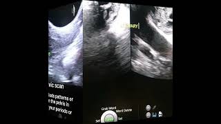 Choroid plexus cyst [upl. by Barmen]